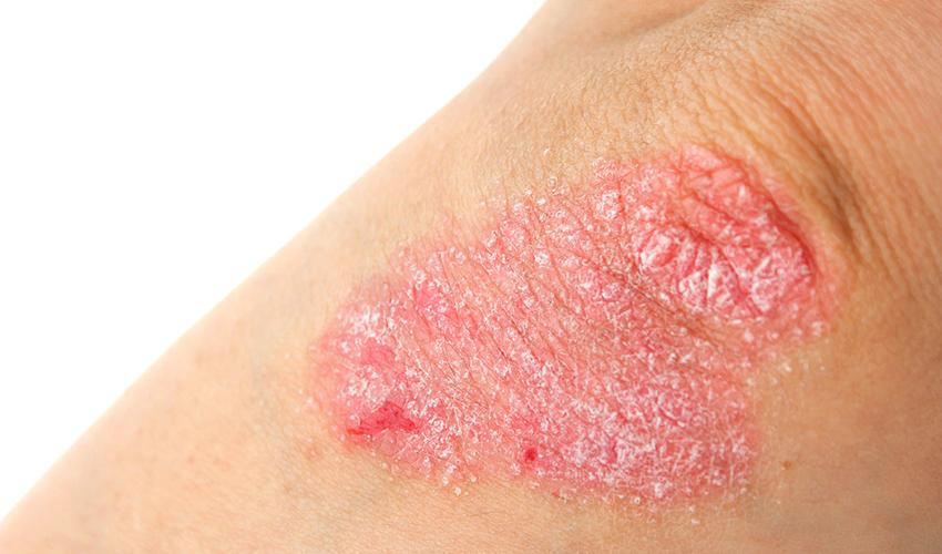 Psoriasis: una enfermedad inflamatoria sistémica que exige abordaje integral Psoriasis: una enfermedad inflamatoria sistémica que exige abordaje integral