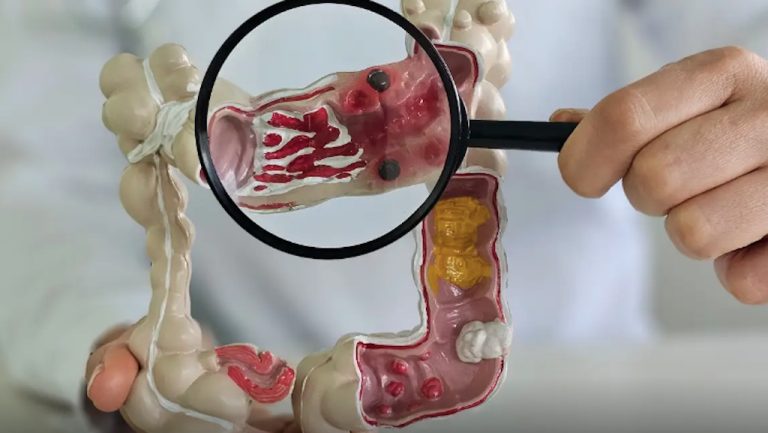 Casos de doença intestinal aumentam cinco vezes no país